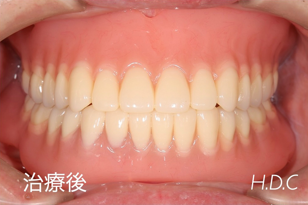 義歯治療例②　治療後
