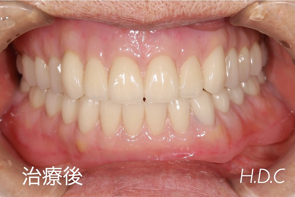症例紹介　治療後
