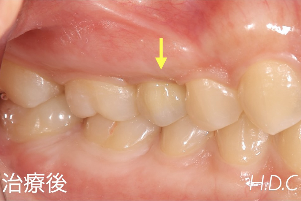 審美補綴症例③　治療後